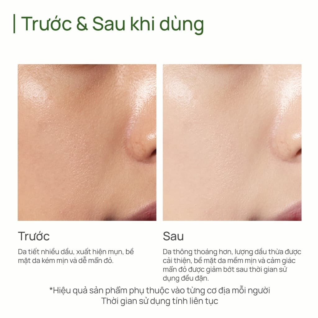CHANDO Nước hoa hồng Salicylic Acid Oil-control & Anti-acne Toner 150ml thumb 5